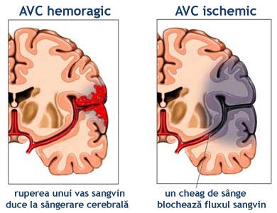 Alcoolul factor de risc pentru accidentul vascular cerebral